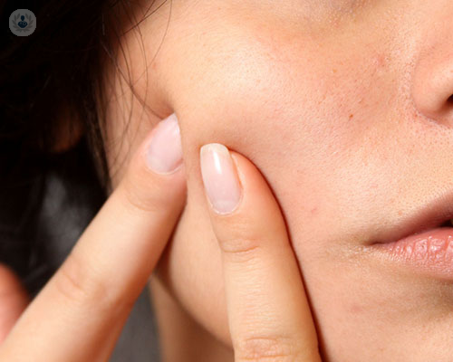 Which route is right for me? How to banish acne scars