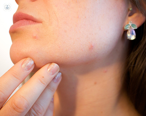 All you need to know about acne treatments