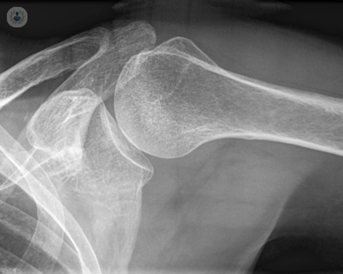 Shoulder arthroscopy: risks and recovery