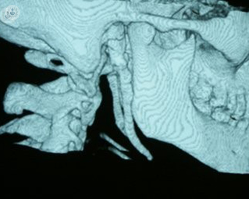 Eagle Syndrome: a close-up of this rare pathology