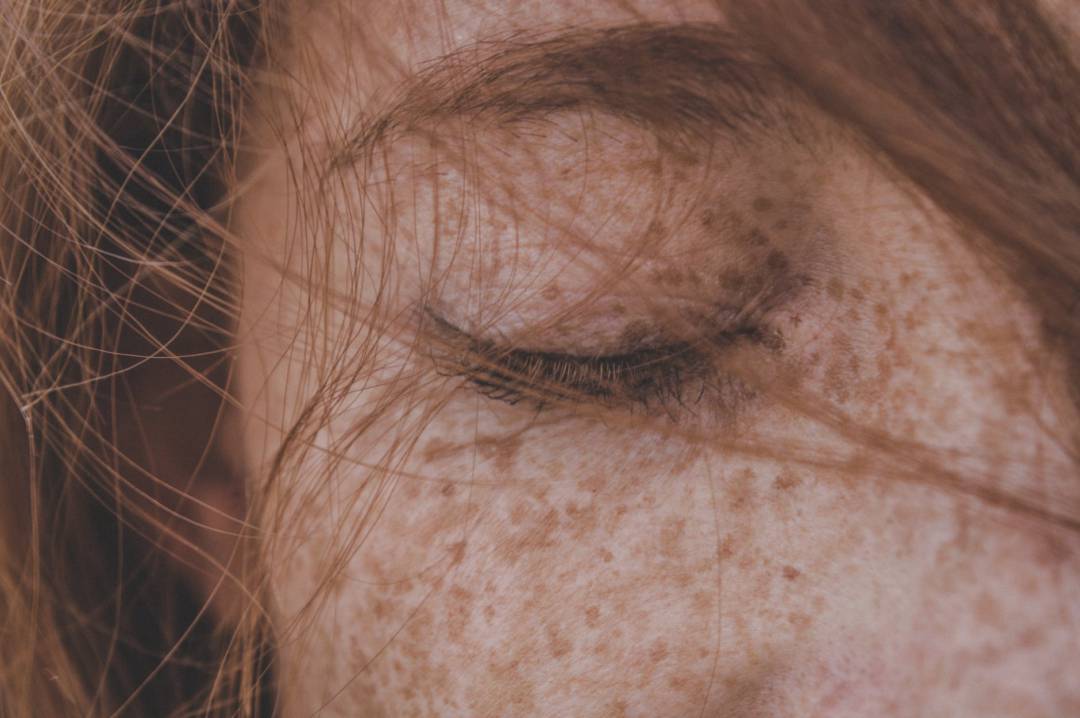 skin-pigmentation-causes-methods-of-prevention-and-treatment صورة المقال