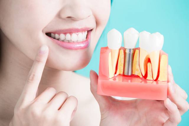 dental-implant صورة المقال
